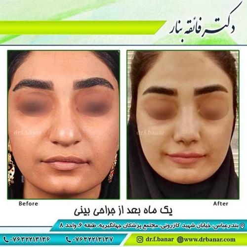 جراحی-بینی-59