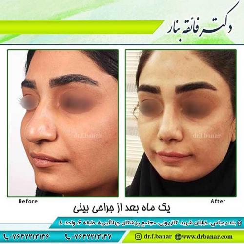 جراحی-بینی-62
