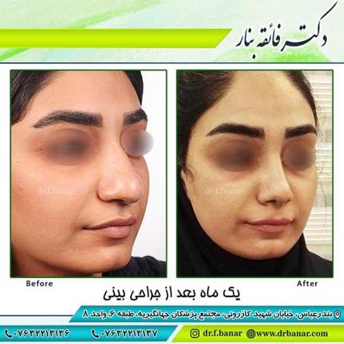 جراحی-بینی-63
