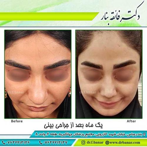جراحی-بینی-64