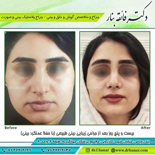 جراحی-بینی-73