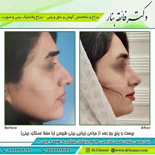 جراحی-بینی-75