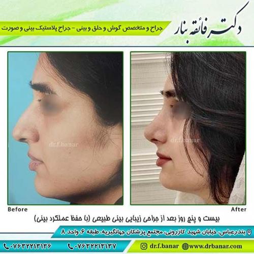 جراحی-بینی-76