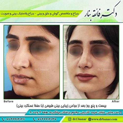 جراحی-بینی-77
