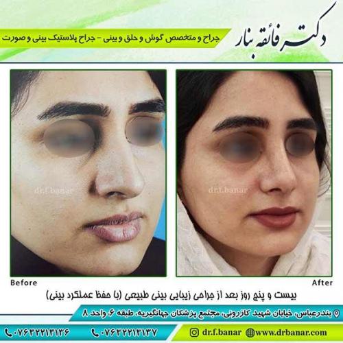 جراحی-بینی-78
