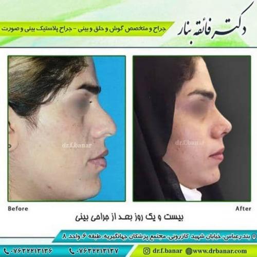 جراحی-بینی-82