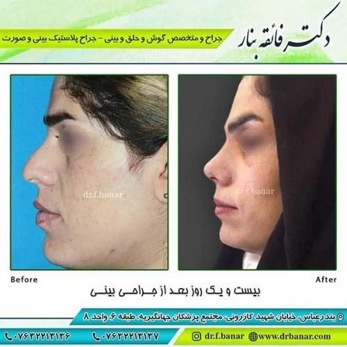 جراحی-بینی-85