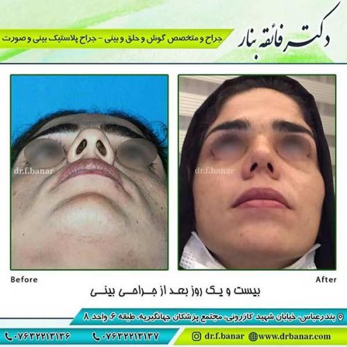 جراحی-بینی-86