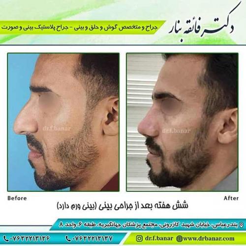 جراحی-بینی-91