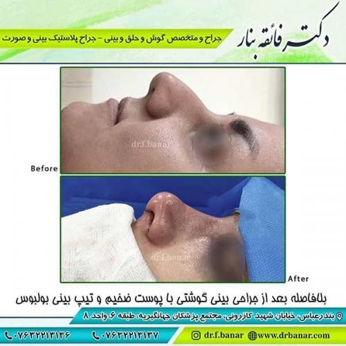 جراحی-بینی-95