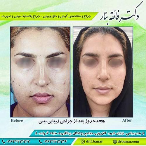 جراحی-بینی-بندر-عباس-1-26