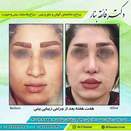 جراحی-بینی-بندر-عباس-1-27
