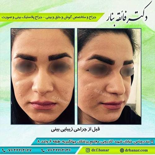 جراحی-بینی-بندر-عباس-1-30