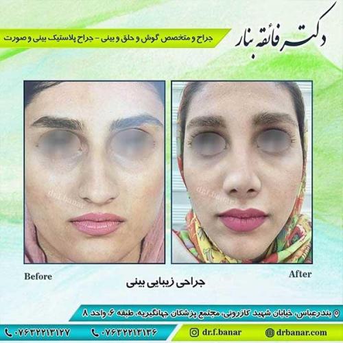 جراحی-بینی-بندر-عباس-1-35