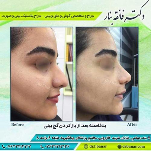 جراحی-بینی-بندر-عباس-1-36