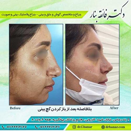 جراحی-بینی-بندر-عباس-1-37