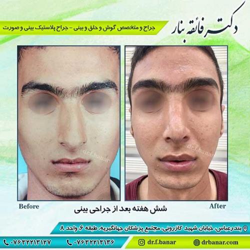 جراحی-بینی-بندر-عباس-1-38