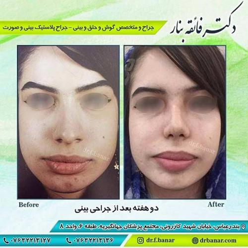 جراحی-بینی-بندر-عباس-1-39