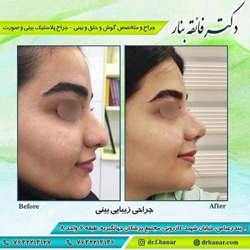 جراحی-بینی-بندر-عباس-1-40