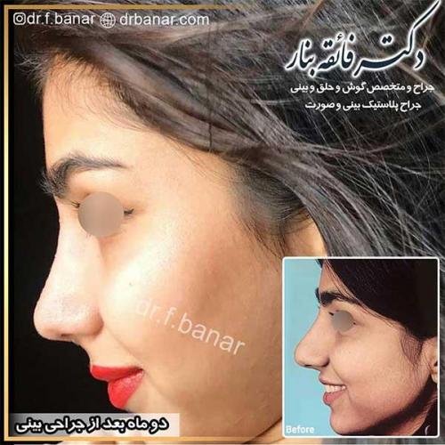 جراحی-بینی-بندر-عباس-1-42