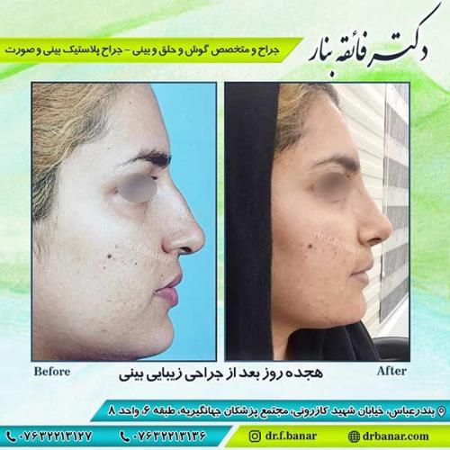 جراحی-بینی-بندر-عباس-2-26