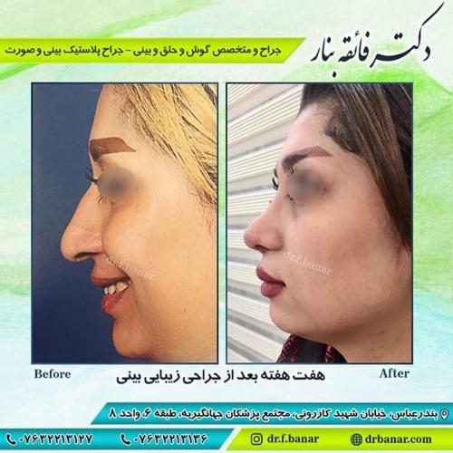 جراحی-بینی-بندر-عباس-2-27