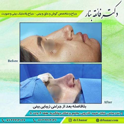 جراحی-بینی-بندر-عباس-2-28
