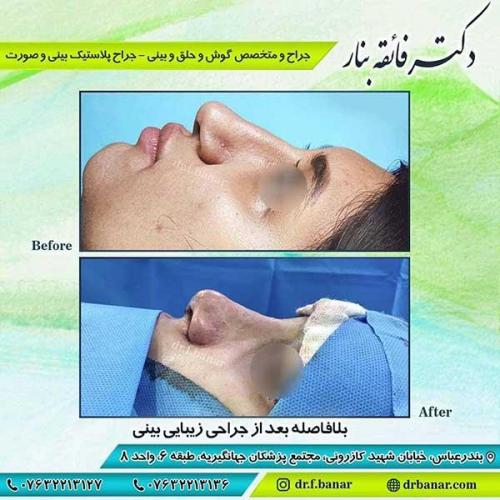 جراحی-بینی-بندر-عباس-2-30