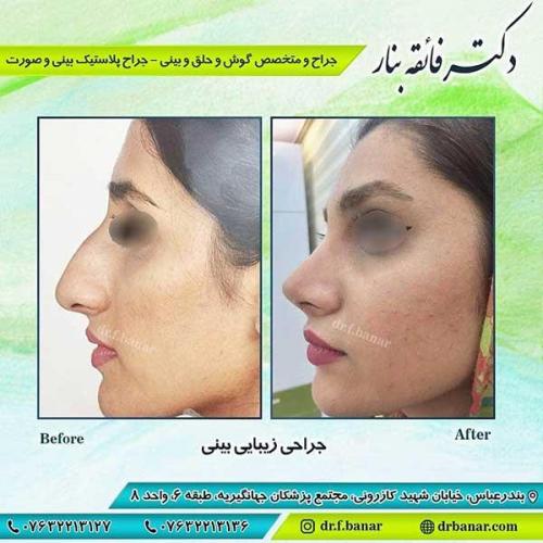جراحی-بینی-بندر-عباس-2-35