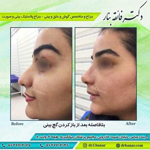جراحی-بینی-بندر-عباس-2-36