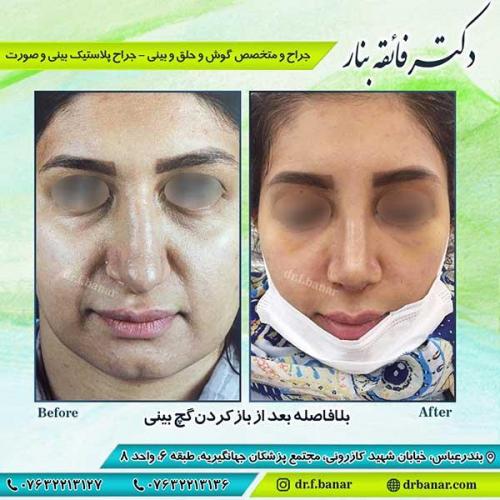 جراحی-بینی-بندر-عباس-2-37