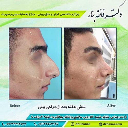 جراحی-بینی-بندر-عباس-2-38