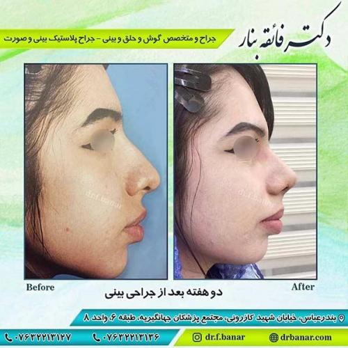 جراحی-بینی-بندر-عباس-2-39