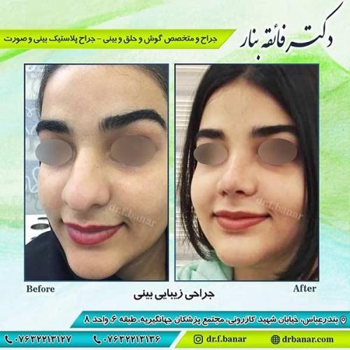 جراحی-بینی-بندر-عباس-2-40
