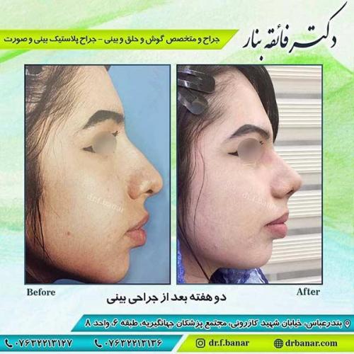 جراحی-بینی-بندر-عباس-2-41