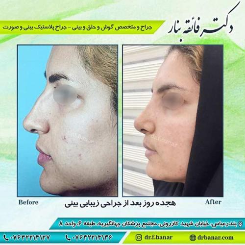جراحی-بینی-بندر-عباس-3-26