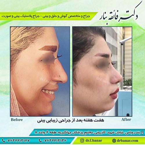 جراحی-بینی-بندر-عباس-3-27