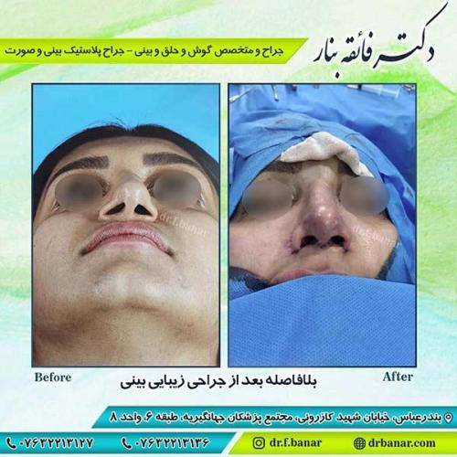 جراحی-بینی-بندر-عباس-3-28