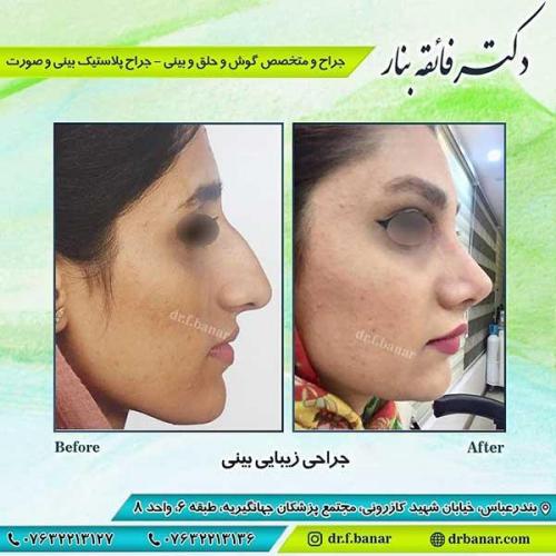 جراحی-بینی-بندر-عباس-3-35