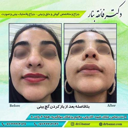 جراحی-بینی-بندر-عباس-3-36