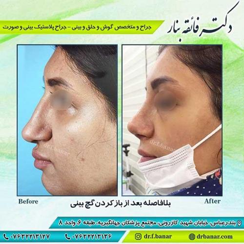 جراحی-بینی-بندر-عباس-3-37
