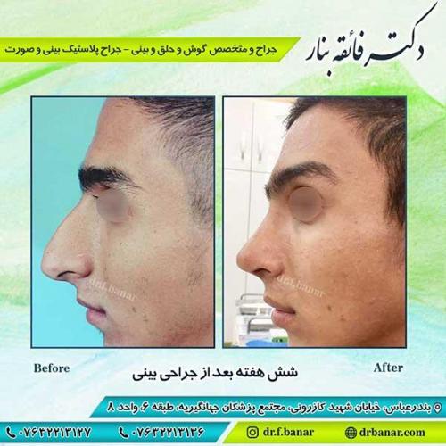 جراحی-بینی-بندر-عباس-3-38