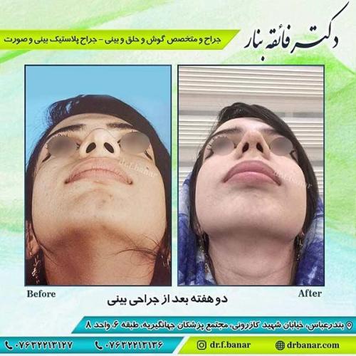 جراحی-بینی-بندر-عباس-3-39