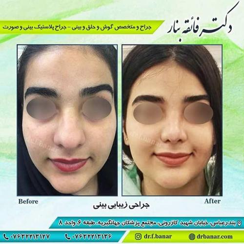 جراحی-بینی-بندر-عباس-3-40