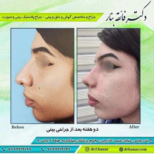 جراحی-بینی-بندر-عباس-3-41