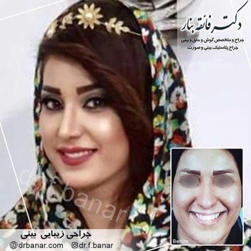جراحی-بینی-بندر-عباس-31