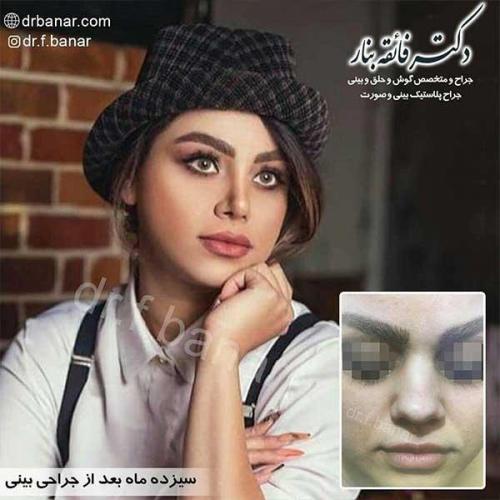 جراحی-بینی-بندر-عباس-32