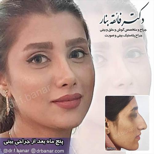 جراحی-بینی-بندر-عباس-33