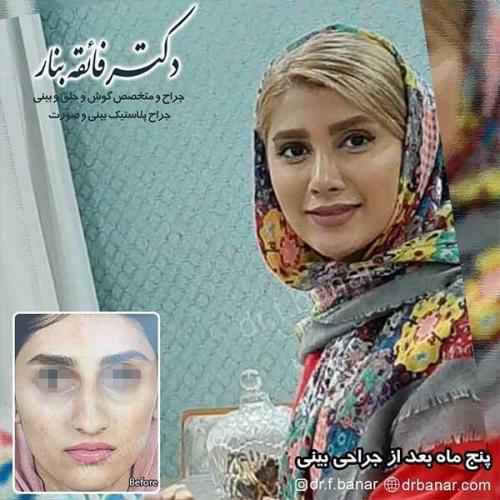 جراحی-بینی-بندر-عباس-34