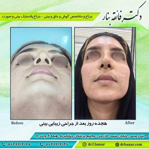 جراحی-بینی-بندر-عباس-4-26